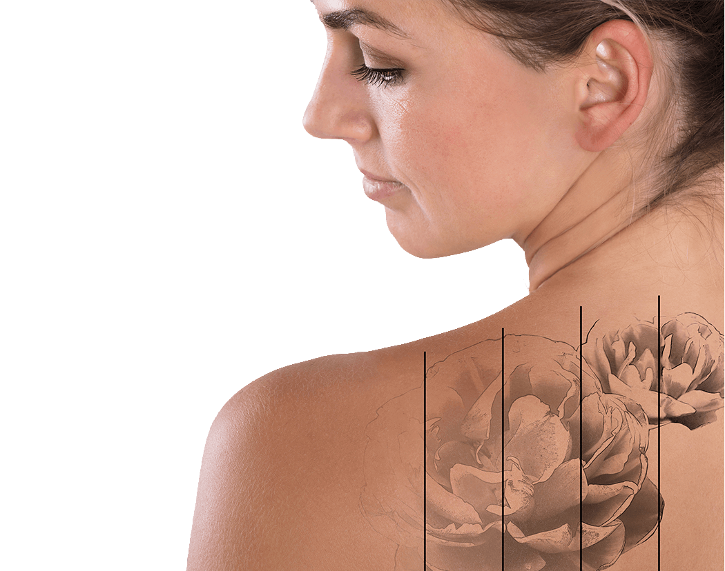 tattoo-removal-back