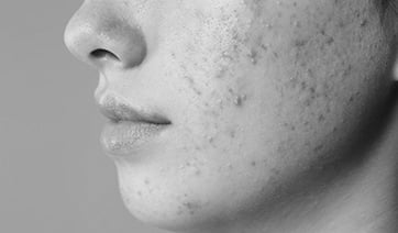 girls-face-with-acne-1