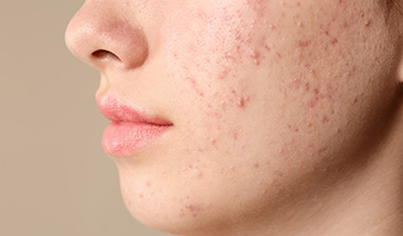 girls-face-with-acne