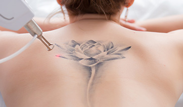 laser-tattoo-removal-back