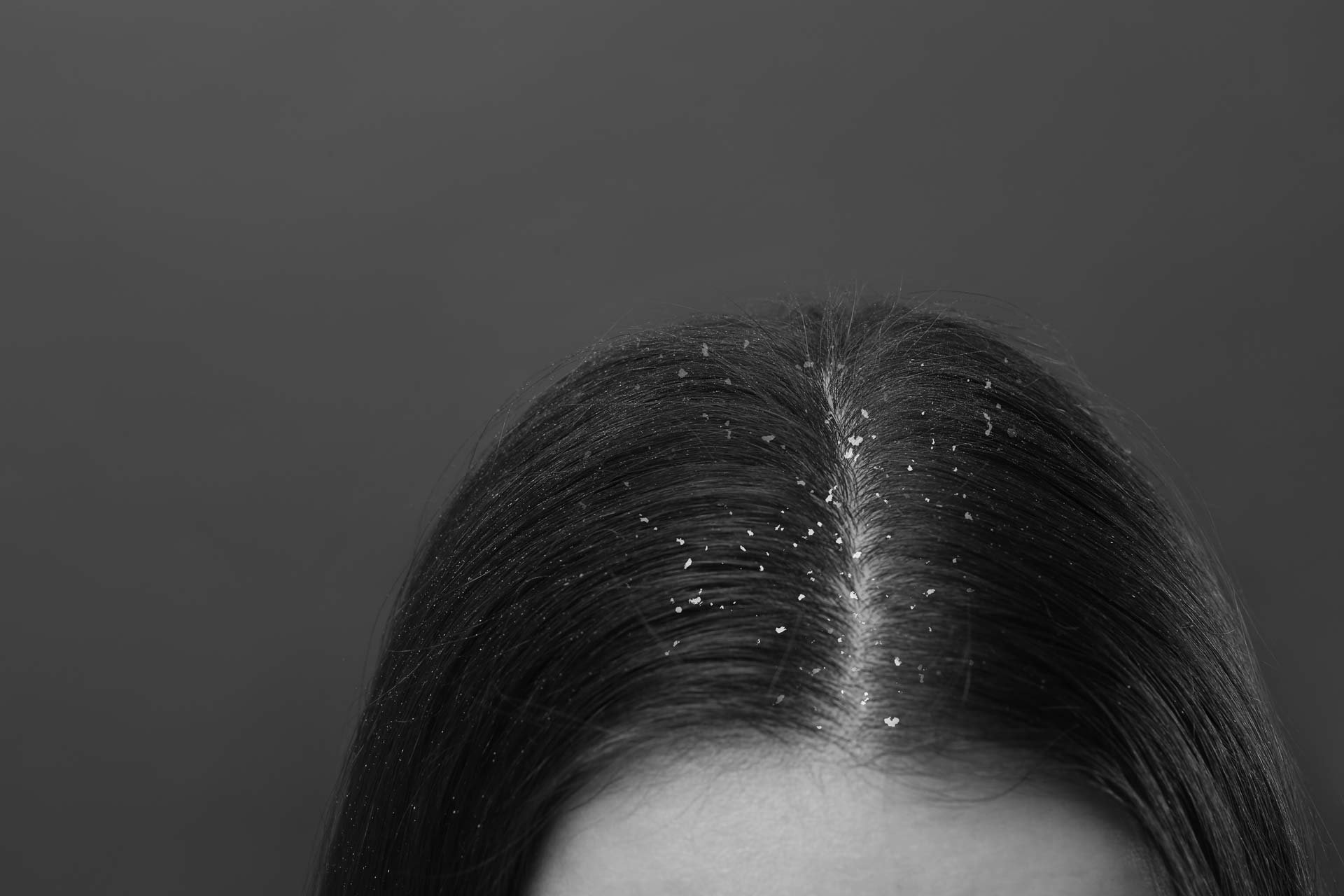 scalp-buildup-closeup
