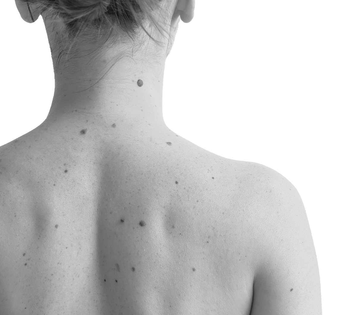 woman-back-birthmarks-1