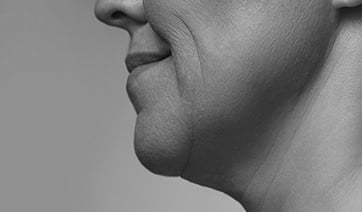 woman-sagging-neck-closeup-1