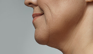 woman-sagging-neck-closeup