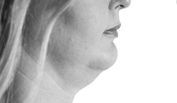 woman-with-receding-jaw-1