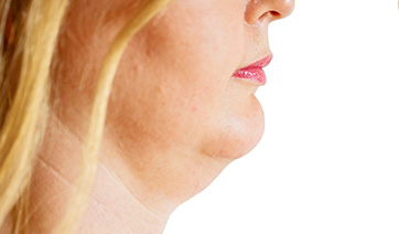 woman-with-receding-jaw